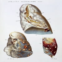 Pluća, bolesti, ilustracija, poster Print od izvora nauke