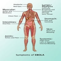 Simptomi virusa ebole u ljudskom, ilustraciji Poster Print by Gwen Shockey Science izvor