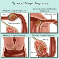 Etopični zapis za trudnoću Ispis Gwen Shockey Science izvor